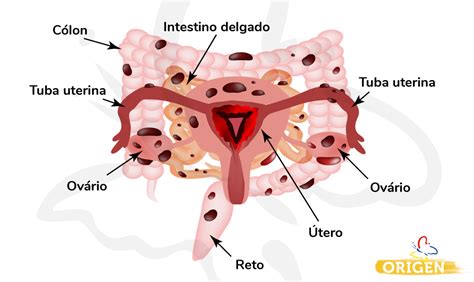 endometriose profunda infiltrativa